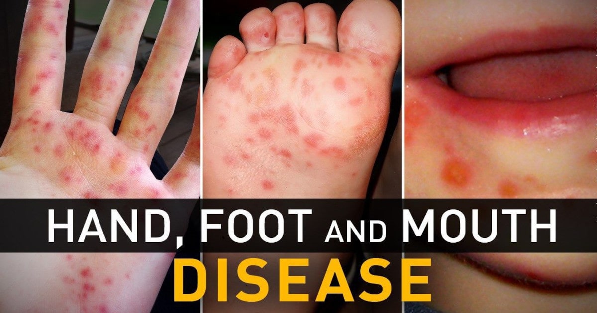 Hand, Foot, and Mouth Disease in Children: A Common Viral Infection ...